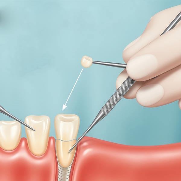 wisdom-tooth-removal-treatment